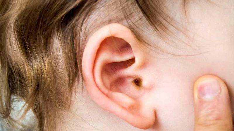 uzmani uyardi orta kulak iltihabi cocuklarda gecici isitme kaybina neden olabilir Agx63PI6
